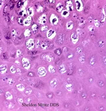 人类乳头瘤病毒(HPV)。上坡的气孔细胞