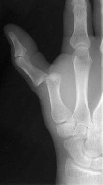 Thumb metacarpophalangeal (MCP) joint dislocation.