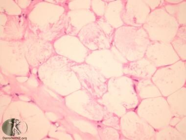 Needle-shaped crystals are arranged radially in ad