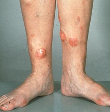 Tumorous lesions on the legs in a patient with dif