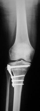 Surgical Treatment of Medial Compartment Arthritis