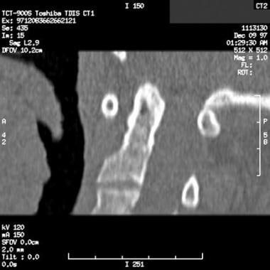 Sagittal CT scan reconstruction that shows widenin