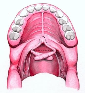 Schematic showing rotation of palatopharyngeal fla