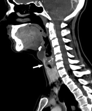 Sagittal contrast-enhanced CT in the same patient 