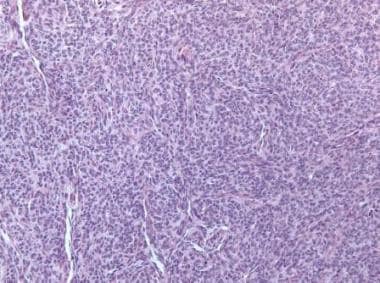 Granulosa cell tumor, diffuse pattern (hematoxylin