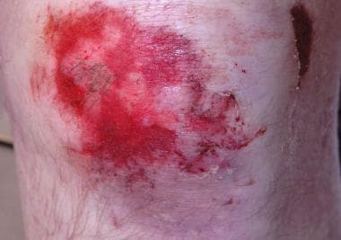 Abrasion on the knee. 
