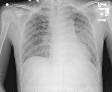 Chest radiography of patient with miliary tubercul