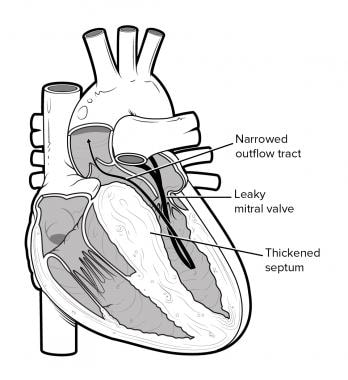 Hypertrophic cardiomyopathy. 