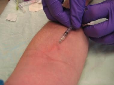 Subcutaneous injection of local anesthetic for IV 
