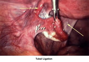 Infertility. Tubal ligation. Image courtesy of Jai