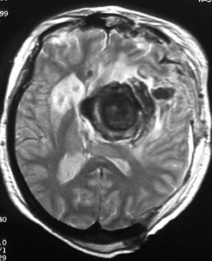 T2-weighted MRI of a middle-aged woman with progre