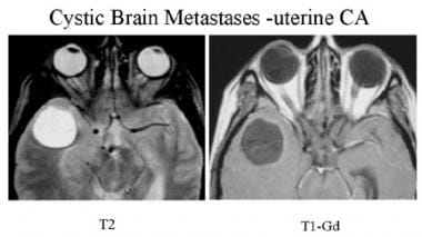 T2-weighted and postcontrast T1-weighted MRI of a 