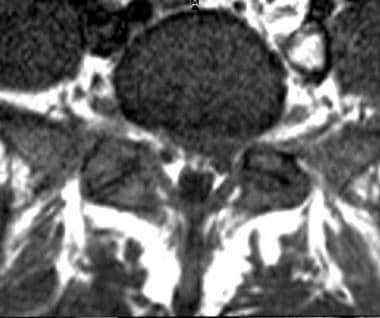 Axial T1-weighted image shows protrusion of a left