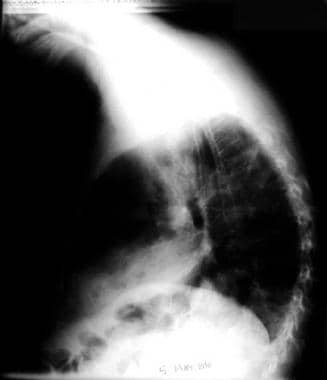 Lateral chest radiograph (same patient as in the p