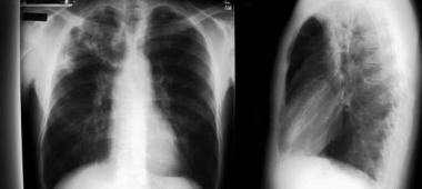 Nontuberculous mycobacteria lung disease