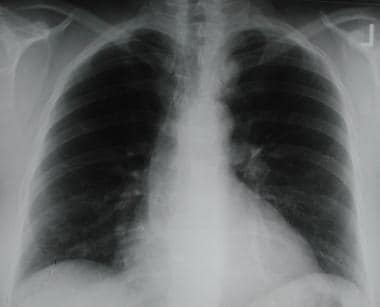 Solitary pulmonary nodule. Posteroanterior chest r
