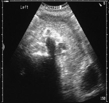 A sonogram obtained through the gallbladder fossa 