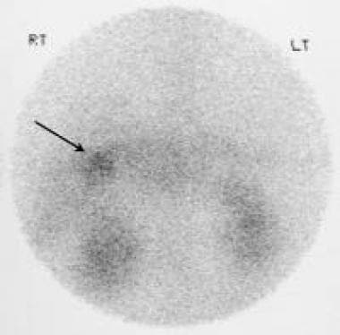 Indium-labeled octreotide scan shows radionuclide 
