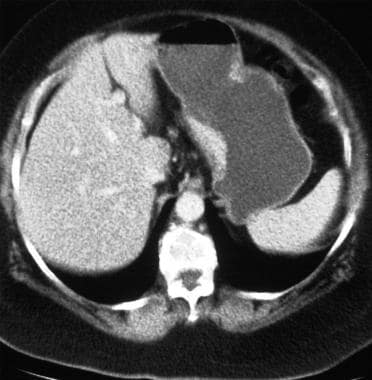 Carcinoma of the lesser curve. Note the focal mura