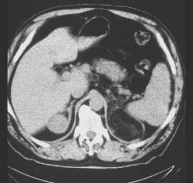 Contrast-enhanced CT reveals a left adrenal mass w