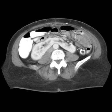 Axial computed tomography (CT) scan obtained throu