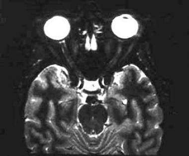 normal optic nerve mri