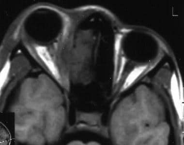 Axial MRI shows right intraorbital extension of si
