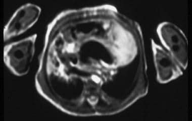 Contrast-enhanced cardiac-gated T1-weighted MRI sh