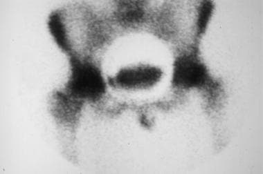 Planar bone scan of the pelvis in a patient with b