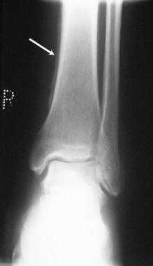 Anteroposterior radiograph of the right ankle in a