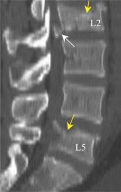 Icd 10 Code For T11 Vertebral Fracture