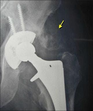 Image from a patient who had a total hip arthropla