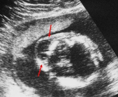 Oblique transverse ultrasonogram of the fetal skul