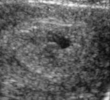 Magnified transverse sonogram shows a complete hyd
