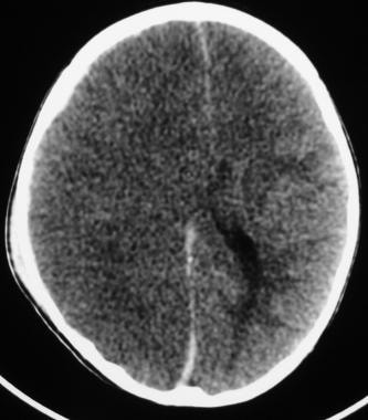 Subarachnoid Hemorrhage. Acute cerebral ischemic i