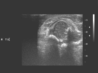 Real-time transverse sonogram of the right hip obt