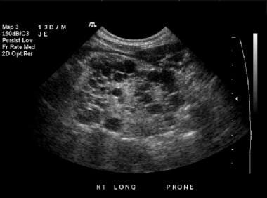 A longitudinal sonogram of the right kidney shows 