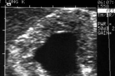 High-detail sonogram of an involved kidney shows a