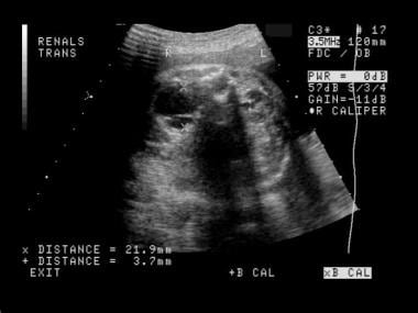 Prenatal transverse ultrasonograms of the abdomen.