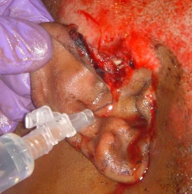 Infiltration of local anesthesia (Note: Image show