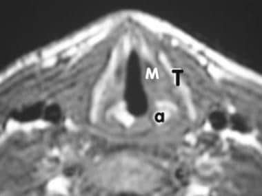 MR imaging, larynx. Image 1 of 3. Axial T1-weighte