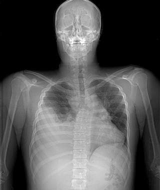一个19岁的ADO的胸部射线照片（Scout View）