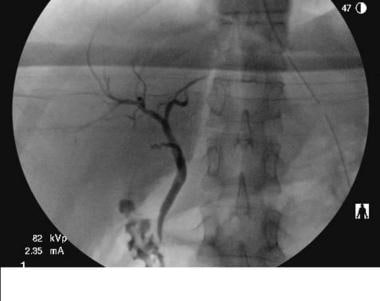 Intraoperative cholangiogram reveals normal bile d