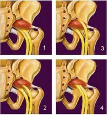 Sciatic Nerve Decompression: Background, Indications, Technical  Considerations