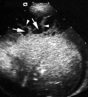 Ultrasonogram of the effusion in a 3-year-old chil