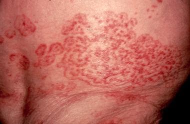 erythema gyratum repens