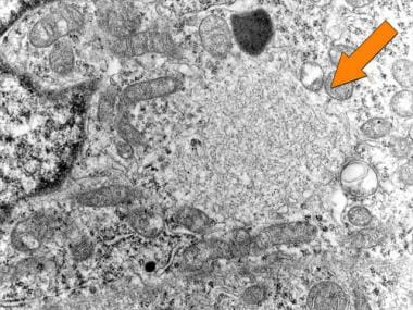 Electron micrograph of Merkel cell carcinoma showi
