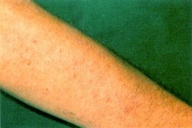 Hyperkeratotic lesions of the skin may involve aca