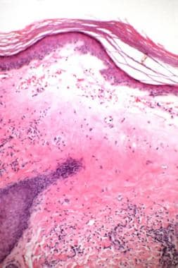 Late lichen sclerosus may show less edema in the u
