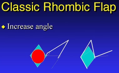 Classic rhombic flap. 